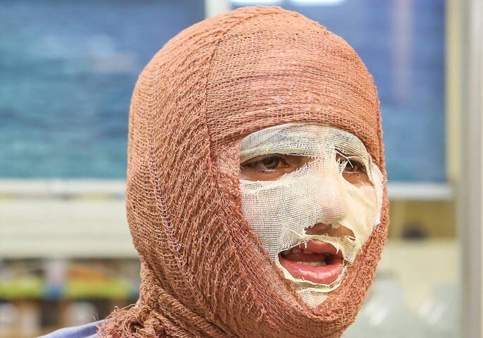از کمبود تخت تا هزینههای سنگین درمان؛ روایت سوختگی در ایران از کمبود تخت تا هزینههای سنگین درمان؛ روایت سوختگی در ایران