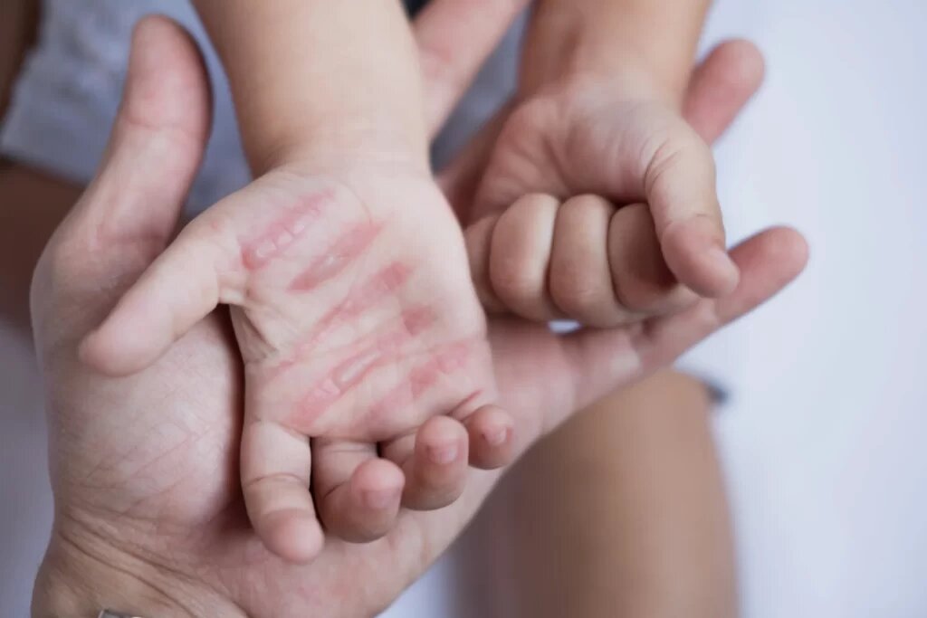 از کمبود تخت تا هزینههای سنگین درمان؛ روایت سوختگی در ایران از کمبود تخت تا هزینههای سنگین درمان؛ روایت سوختگی در ایران