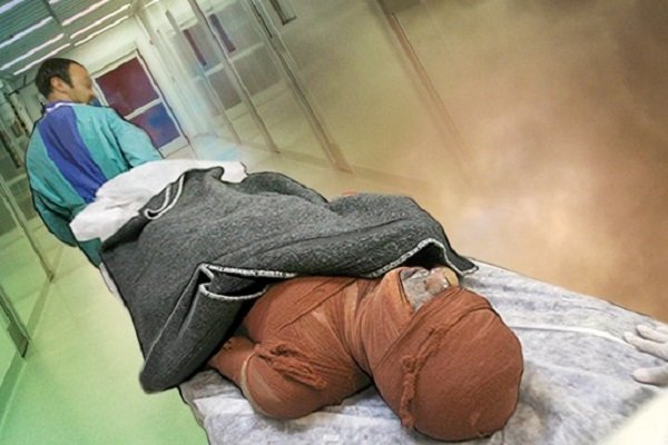 از کمبود تخت تا هزینههای سنگین درمان؛ روایت سوختگی در ایران از کمبود تخت تا هزینههای سنگین درمان؛ روایت سوختگی در ایران
