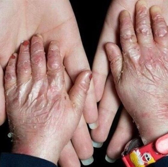 گوشه‌ای از مصائب بیماران پروانه‌ای/زندگی با بیماری نادر/ دست‌هایی که با پانسمان گره خورده‌اند