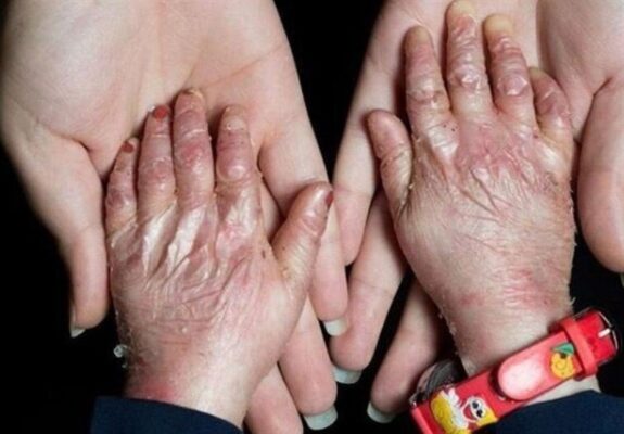 گوشه‌ای از مصائب بیماران پروانه‌ای/زندگی با بیماری نادر/ دست‌هایی که با پانسمان گره خورده‌اند