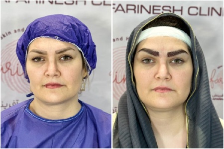 فرق میکروکاشت با کاشت ابرو چیست فرق میکروکاشت با کاشت ابرو چیست