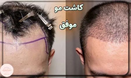 کاشت مو طبیعی کاشت مو طبیعی