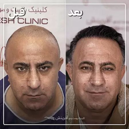 مهمترین نشانه های کاشت مو موفق مهمترین نشانه های کاشت مو موفق