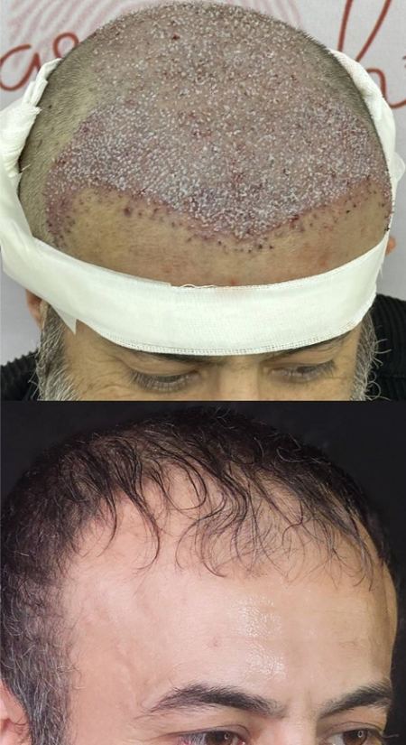 طبیعی بودن خط رویش مو در کاشت مو طبیعی بودن خط رویش مو در کاشت مو