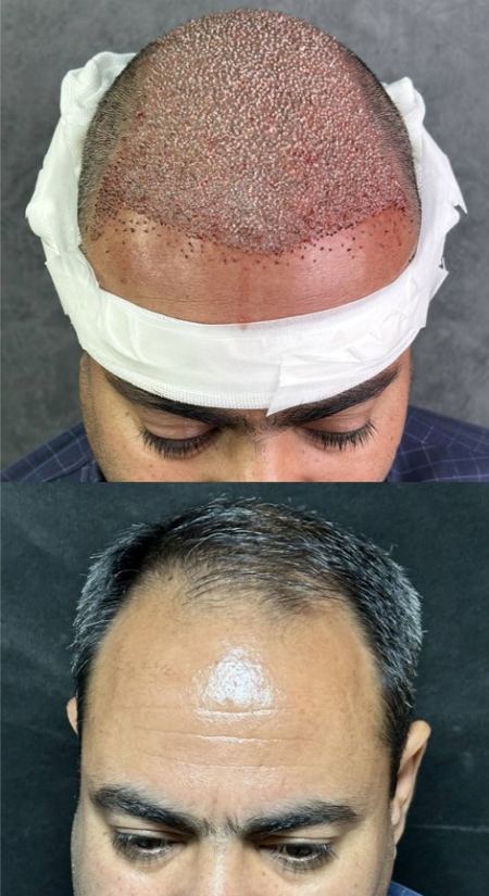 کاشت مو طبیعی کاشت مو طبیعی