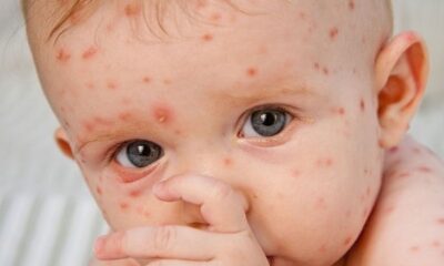 شیوع «آبله مرغان» در بهار