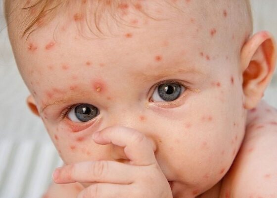 شیوع «آبله مرغان» در بهار