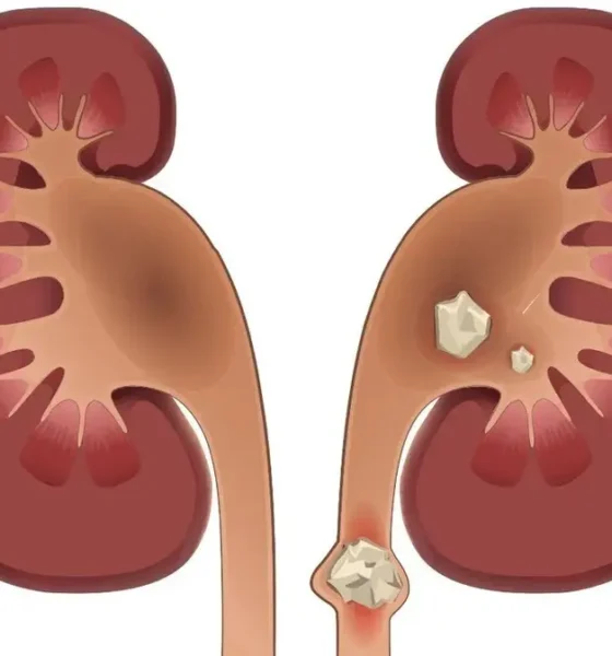 سنگ کلیه چه علائمی دارد؟